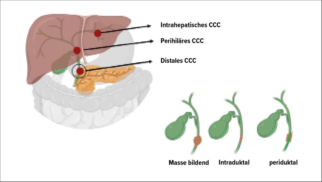 Diagnostik und Therapie primärer Lebertumoren - Onkologie - Universimed ...